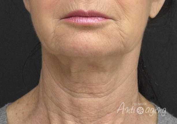 Sculptra Treatment: A Revolutionary Approach to Facial Rejuvenation Sculptra Treatment: A Revolutionary Approach to Facial Rejuvenation
