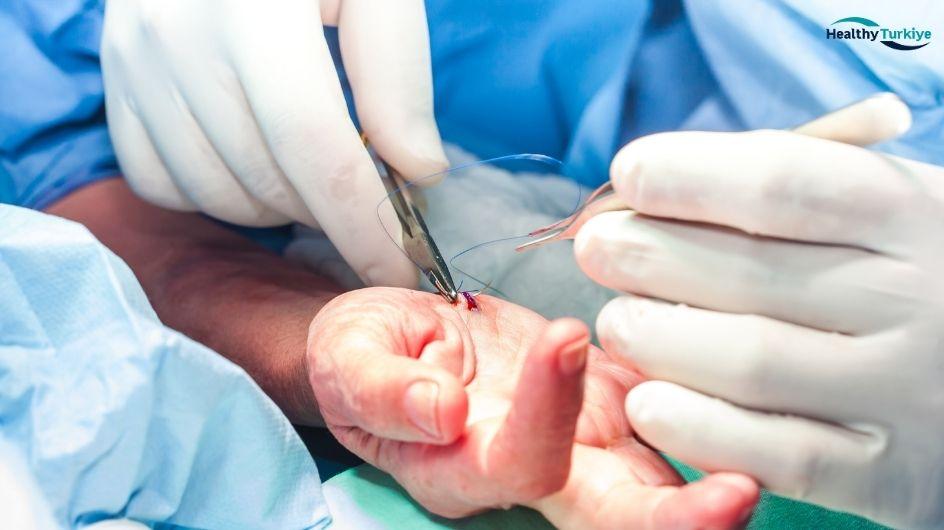 Hand Surgery in Turkey: Expert Care for Hand Conditions Hand Surgery in Turkey: Expert Care for Hand Conditions